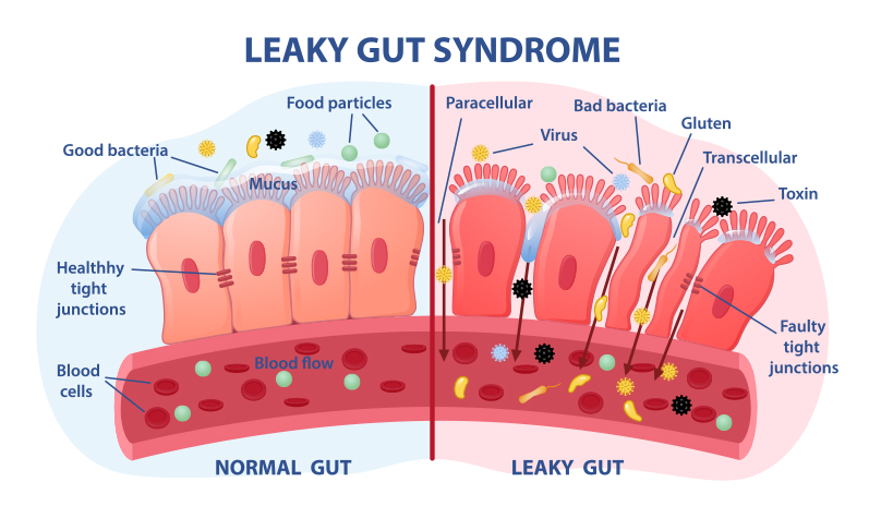 leaky gut syndrome image